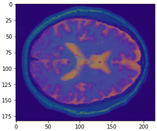 MD image overlaid on a T1 Weighted MRI