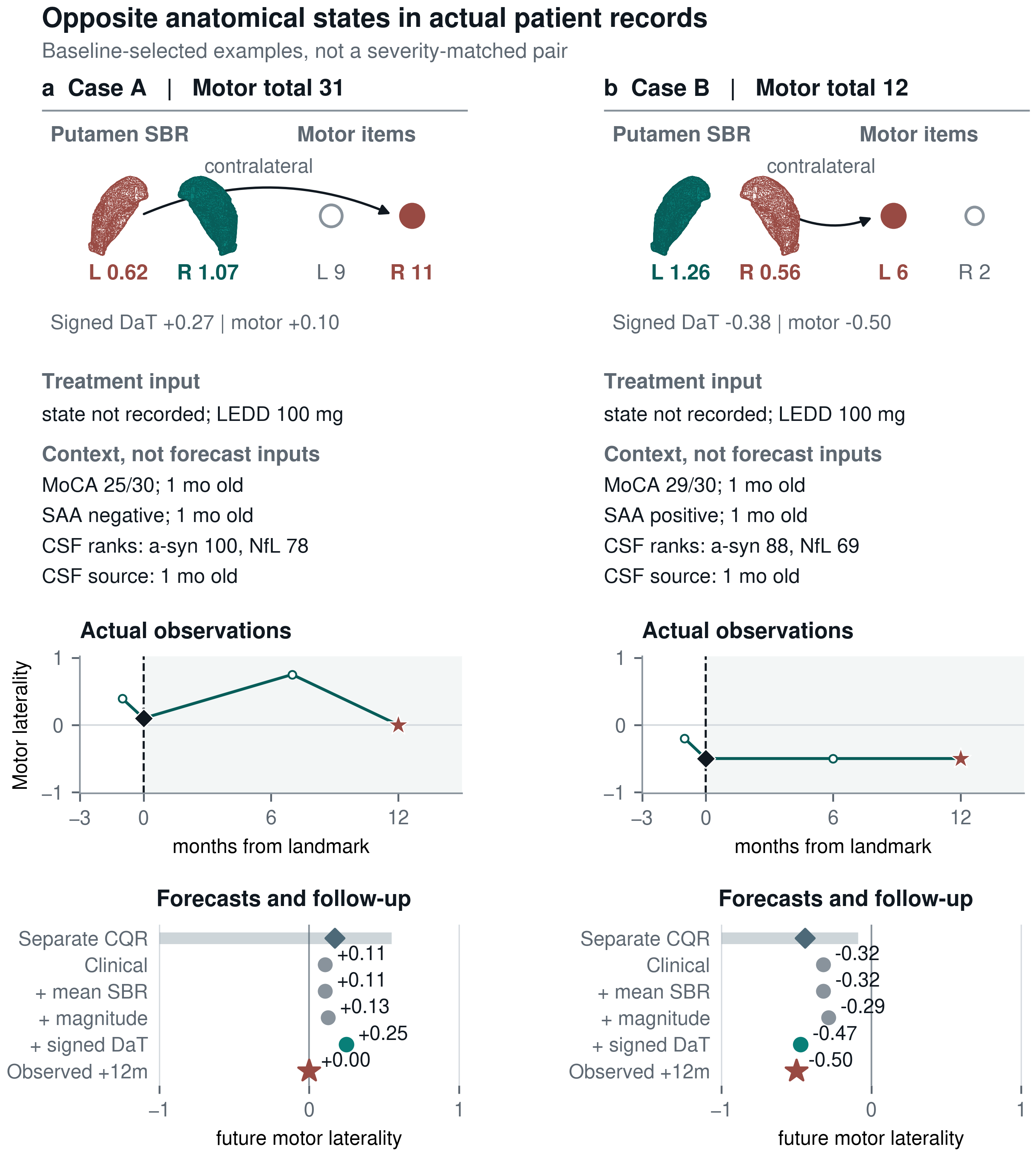 Two de-identified outcome-blind PPMI histories showing mirror-image signed dopaminergic and motor states